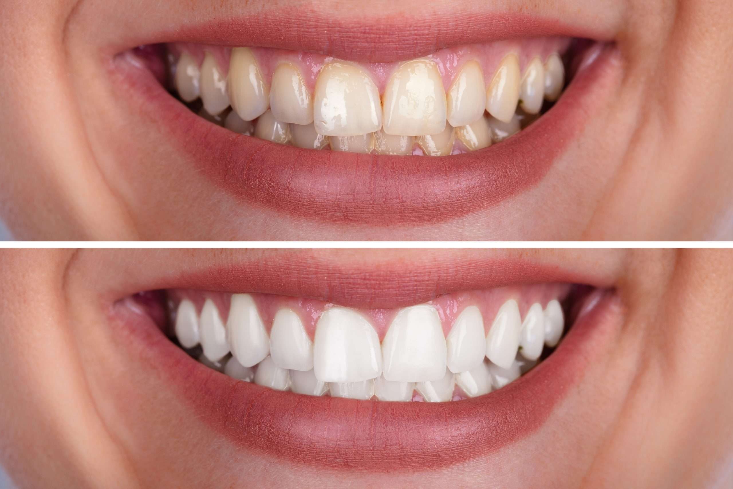 teeth whitening 2